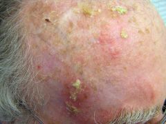 Dry, hard, rough, and scaly papules
in sun exposed areas of skin 
Scraping will not cause bleeding
