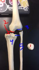 Knee joint
1. Patella

2. Medial condyle

3. Lateral condyle

4. Tibia

5. Fibula
