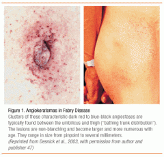 XLD. lysosomal storage disease - def alfa-galactosidase A.
מתחיל בגיל שנתיים עם כאב ופרסטזיה בגפיים מלווה באנגיוקרטומות המצטברות לרוב באזור הירכיים, בין הטבור לב...
