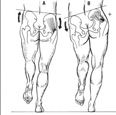 Si se da la caída de la región glútea del miembro elevado, es sinónimo de luxación de cadera o de insuficiencia de los músculos glúteos del lado opuesto