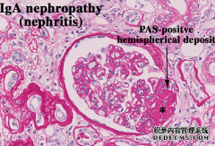 IgA nephropathy
most common chronic glomerular disease worldwide

URI and GI infections

normal C3
mild proteinuria and mild/mod HTN

HTN = most important thing to control