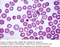 hemolytic uremic syndrome

most common ARF in young kids
1. microangiopathic hemolytic anemia
2. thrombocytopenia
3. uremia

e. coli 0157:H7
shigella
salmonella
campylobacter