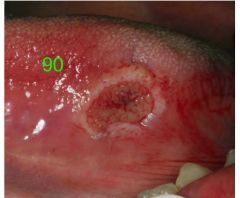 o	65 year male with a chief complaint of sore tongue
o	Patient reports that he frequently bites his tongue
o	Patient is a social smoker and drinker
o	His father has a history of GI cancer
•	Description: 
o	 ulcerated lesion  with elevated m...