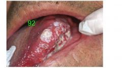 o	A 60-year-old male was referred to the WU clinic for evaluation of a mass in his tongue which the patient felt was just infection.
o	The lesion was first noticed by his dentist two months ago and considered to be due to local trauma caused by a...