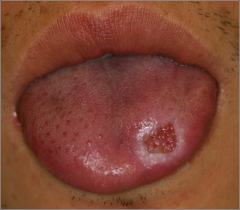 o	38 year old male 
o	This man has had a painful area of his tongue for more than 3 months. 
o	It has remained unchanged since it first appeared.   
o	He remembers biting his tongue at the start of the lesion. 
o	He has been diagnosed with ulc...