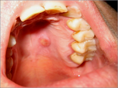 o	44 year old female
o	 This woman experienced a sudden-onset sharp pain of her palate 1 week ago. 
o	At that time she noticed a “lump” in the region, which ulcerated shortly thereafter. 
o	Pain has persisted unchanged
o	She has a history ...