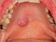 o	72 year old female
o	 This woman has been aware of a painless mass of her palate for at least 5 months. 
o	It has enlarged continuously since she first noted it. 
o	She has a history of breast adenocarcinoma, treated 9 years earlier.
•	Des...