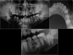 o	14 year old male
o	This boy had his right mandibular first molar extracted 6 months earlier because of severe caries. 
o	He now revisits his dentist because of an enlarging alveolar swelling of the facial surface of his posterior left mandible...