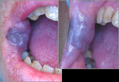 o	55 year old female
o	Lesion of right anterior buccal mucosa, commissure area present since childhood