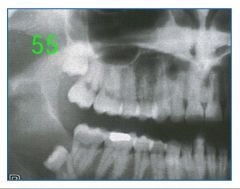 o	25 year old female patient with impacted third molars. 
o	Patient was in with a CC of pain in the area.
