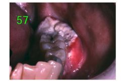 o	This 72-year-old woman had just recovered from an episode of herpes zoster in her sacral region when she noticed soreness of her left mandible. Her dentist had removed a tooth in this area one year earlier.  Antibiotics given by her physician di...