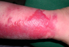 Superficial cellulitis with prominent lymphatic involvement causing lesions that are raised above the level of surrounding skin with a clear line of demarcation between involved and uninvolved tissue


 


Frequently caused by beta-hemolytic ...
