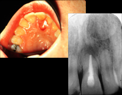 o	Chief Complaint: Patient complains of pain and swelling associated with a front tooth.
o	Clinical Findings: A fluctuant compressible soft tissue swelling is associated with the lingual of the affected area. Probing of the swelling causes discha...