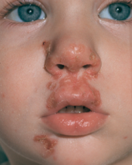 - Superficial skin infection


- "Honey" crusts


- May be vesicular or bullous


- In children often around the nose and mouth