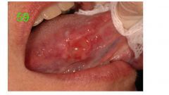 o	36y female, a professional soprano
o	History of ‘aphthous ulcer’ on the tongue for two years
o	Treated by a ENT friend for ‘aphthous ulcer’ over two years with no biopsies done.