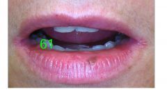 •	Clinical Information: 
o	Adult female with an asymptomatic lesion of lower lip that has been present for 3 years.