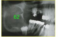 o	50 year old asian male with a radiolucency associated with tooth # 32