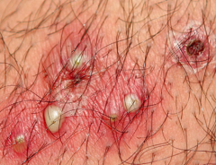 Perifollicular erythema, papule, or pustules


 


Lesions are associated with hair follicles