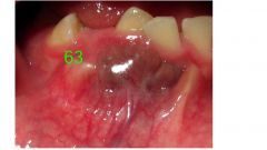 o	A 13-year-old female went to her dentist because of an asymptomatic lump that she had discovered on her gingiva. She had no systemic problems and was taking no medications.