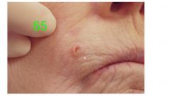 o	85 year old female presents to your office with a complaint of an ulcerated area on her lip
o	When you examine this you note that it has a rodent ulcer look
o	History of squamous cell carcinoma of the lower lip