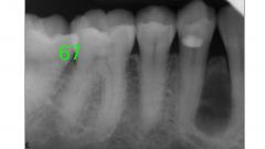 o	40 year old female with an asymptomatic lesion on the radiograph. Teeth are vital