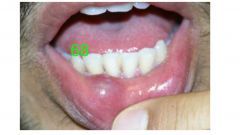 o	This fluctuant mass has been present for 10 days. Patient reports biting it often.
•	Description:
o	Round erythmatic fluctuant mass located on lower lip right mucosal area