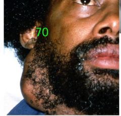 o	This gentleman reports this firm, nonpainful mass has been growing slowly for several months. Other than nicotine stomatitis, he has no other intra-or extraoral lesions.