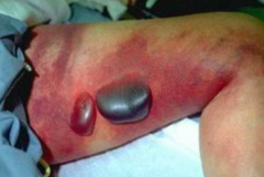 Diffuse swelling of arm and leg, followed by appearance of bullae with clear fluid that may become violaceous in color


 


Marked systemic symptoms like pain out of proportion to skin lesion