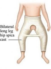Rotación externa de pies, abducción de muslos, y acortamiento de miembros inferiores  



Dn:Posición de fractura de cadera o femur  bilateral
