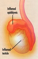 ascending, retrograde urethral infection -> acute scrotal pain/swelling

rare before puberty

main cause of acute scrotal swelling in sexually active men

pyuria

tx = bedrest and abx