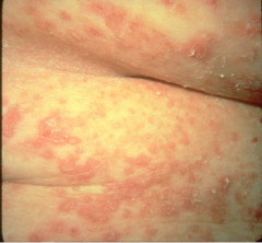 1.  Flaccid bullae
2.  Often only erythematous patches, crusts, or erosions--- cornflakes
3.  Nikolsky sign +
4.  Oral lesions rare