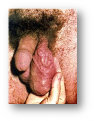 dilatation of pampiniform plexus (valvular incompetence of spermatic vein)

tx = surgery 

"bag of worms" and painless