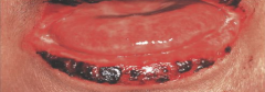 1.  Severe stomatitis extending onto vermilion lip