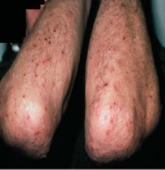 1.  Polymorphous, grouped, symmetrical lesions
2.  Often excoriated--- severe pruritus
3.  Elbows, knees, buttocks, scalp, scapula