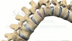 compression of anterior aspect of vertebral body from forced flexion of the thoracic or lumbar spine