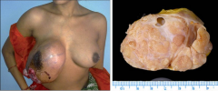 










Mujer de 33 años de edad con tumor en la glándula mamaria derecha la
cual aumenta de tamaño progresivamente hasta el momento de la fotografía.