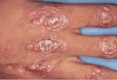 1.  Noninflammatory bullae in traumatized area
2.  Skin fragility
3.  Atrophic scarring
