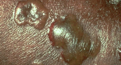 1.  Large, fragile bullae
2.  Rupture leave circinate weepy crusted lesion