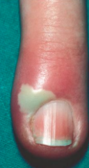 1.  Inflammatory reaction involving folds of skin around fingernail