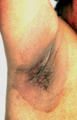 1.  Dry, brown, delineated scaling patches
2.  Located in intertrignous areas
3.  Generally asymptomatic, except in groin
