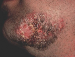 1.  Chronic pustular staph infection of bearded region
2.  Appear after shaving
