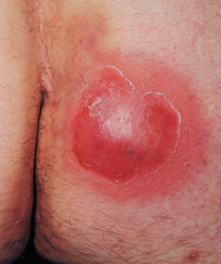 1.  Perifollicular, round, tender abscess that ends in central suppuration