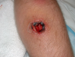 1.  Ulcerative lesion on shins or dorsal feet
2.  Saucer-shaped ulcer when crust is removed