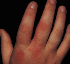 1.  Purplish swelling of hands
2.  Polygonal patches of bluish erythema
3.  Migratory