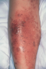 1.  Suppurative inflammation involving subq tissue
2.  MC due to T. pedis on leg