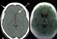 - Left: normal
- Right: Huntingtin Disease (atrophy of caudate and putamen w/ ventricular enlargement and mild to moderate atrophy of the gyri)