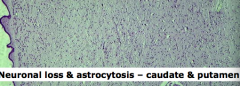 Neuronal loss and astrocytosis in the caudate and putamen
