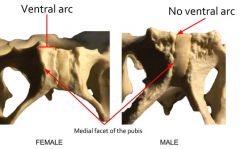 The rough project of bone visible on the anterior surface of the pubis bone