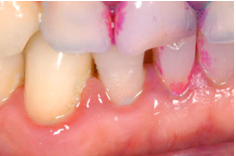 Affects the margins of gingiva and interdental papillae are usually affected.