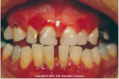 Affects the gingival margin, the attached gingiva and the interdental papillae.